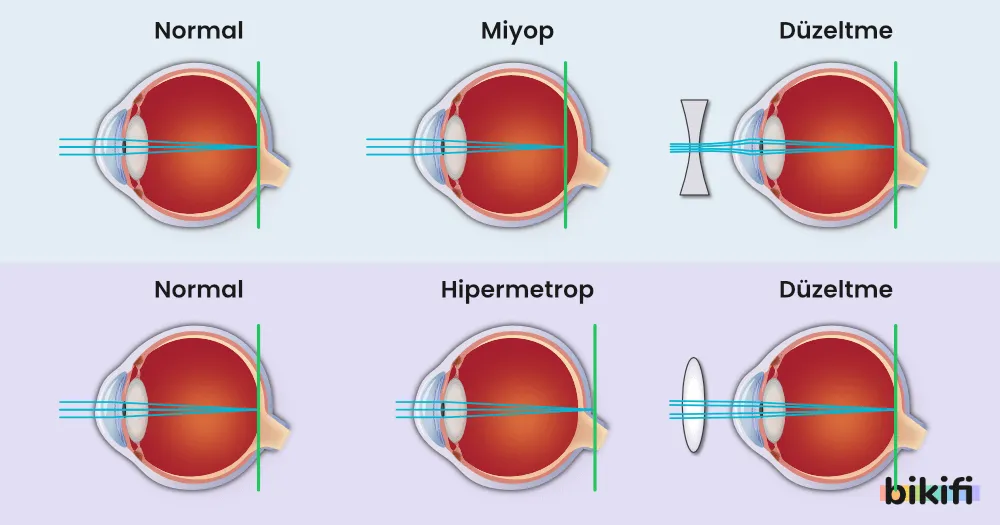 Göz Kusurları, miyop ve hipermetrop